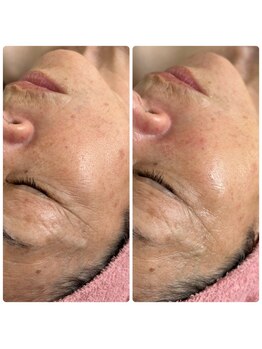 ベリンダ(BELINDA)/話題のピーリング!