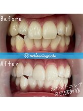 ホワイトニングカフェ 大宮西口店/◎歯のホワイトニング施術写真◎