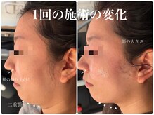 リラ(Lilas)/別人級痩身