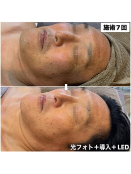 アンリミット(Unlimit)/複合施術で色ムラ.皺.髭.鼻シミ