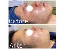 トータルメンズエステ キング(KING)の雰囲気（【男の肌管理】毛穴改善マシン・ハーブピーリングで徹底改善◎）