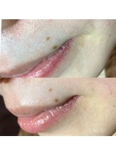 ジル(JILL)/トリプルWAXスキンケアWAX脱毛