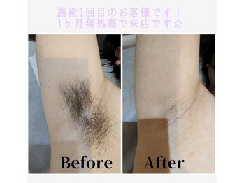 エタニティ(Eternity)/メンズワキ脱毛のお客様です★