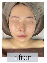 インディバケアプラチナム 恵比寿店/両顎手/術のアフターケア☆after