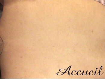 アクール(Accueil)/毛穴ケア/肌質改善/ニキビケア