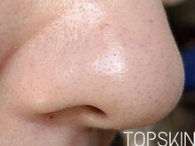 トップスキン 表参道(TOPSKIN)/REVI1回でここまで変わります！