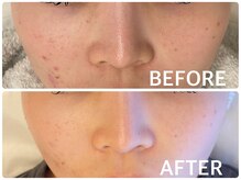 ハーブピーリング 恵比寿/ニキビ/毛穴/くすみ