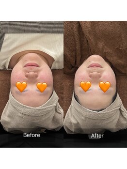 トニック バイ まつもと整骨院鍼灸院(Tonic)/★Before After★豊中/毛穴