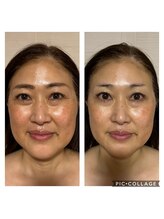 エクレクティック(ECLECTIC)/ハーブピーリング/宇都宮エステ