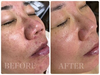 シェミー(CHEZ MEE)/赤み・毛穴・シミ・跡・肌質改善