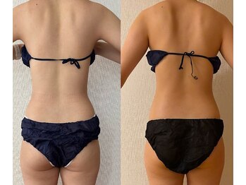 アイリーボーテ 東大阪(アイリーBEAUTE)/ブライダル背中ケア