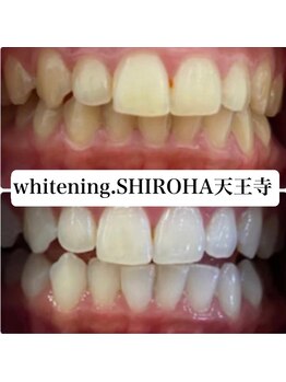 シロハ(SHIROHA)/セルフホワイトニング/天王寺