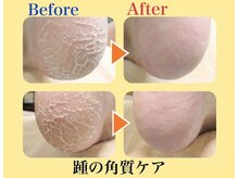 巻き爪補正店 北千住店の雰囲気（踵の角質、たこ、魚の目でお悩みの方へ［フットケア］［北千住］）