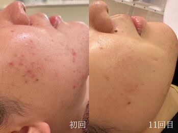 ウォーム(warm)/ニキビケア/肌荒れ/ニキビ肌