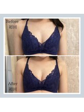 プレミドール(PREMIDOLL)/Before after