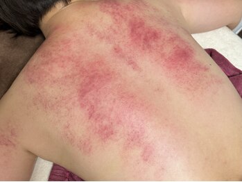 チョアチョア(CHOA-CHOA)の写真/最新美容を身近に、お得に通い続けられる肌管理専門店♪韓国伝統カッサでの老廃物排出促進ボディケア◎