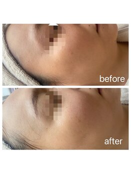 ビアス(VIAS)/美白ケアコース