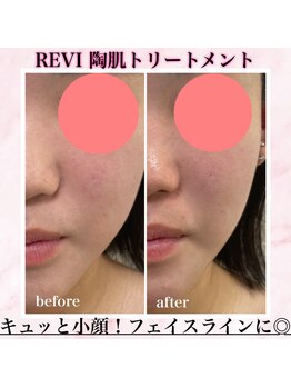 ビ ボーテ(美 Beaute)/REVI ハーブピーリング/小顔
