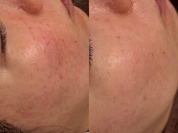 ベル(BELLE)/エンビロンで肌質改善♪