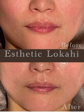 ロカヒ(Lokahi)/ほうれい線スッキリ！