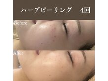 サロンドペシェ(salon de peche)/ハーブピーリング4回の変化