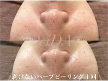 ヴィーダ 渋谷松濤(ViDA)/REVIメンズハーブピーリング