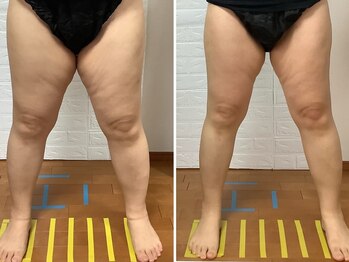 ビューティフルムーン(Beautiful Moon)/12月と1月のBA写真☆脂肪冷却