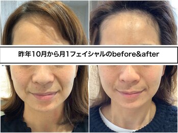 ディアメ(Diame)/毎月の地味重ねで肌質改善♪