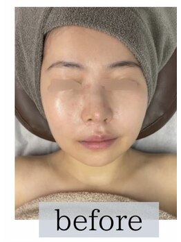 インディバケアプラチナム 恵比寿店/両顎手/術のアフターケア before