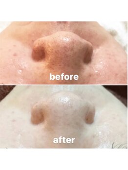 エムズビューティー(M’s Beauty)/カーボンピーリング