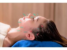 ハリーナ(HARI-NA)/美容鍼