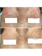 カヌヌ(Kanunu)/シミケア