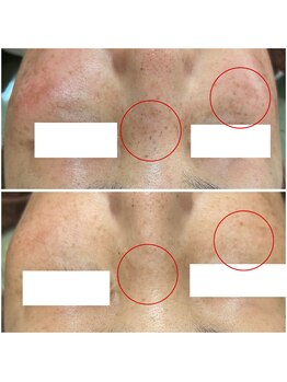 カヌヌ(Kanunu)/シミケア