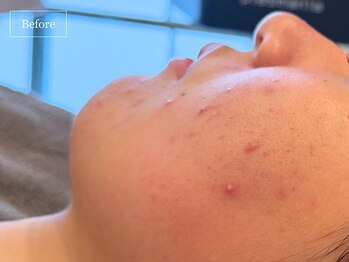 キュレイテッドスキン(CURATED SKIN)/ピーリング/毛穴ケア/肌質改善