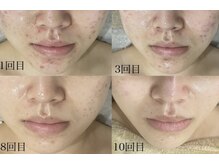 ベル(Belle)/【艶玉肌セルマン】