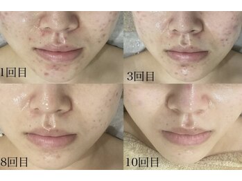 ベル(Belle)/【艶玉肌セルマン】