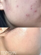 トップスキン 名駅(TOPSKIN)&nbsp;剥離あり 剥離なし