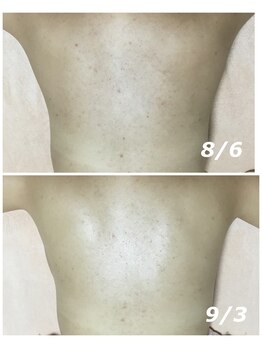 クリスタルボウ(Crystal BEAU)/背中洗浄ニキビケアフォト2回