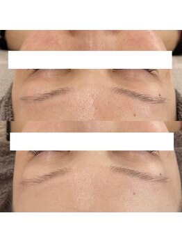 ヴェルシック(Belchic)/瞼の上まで施術可能