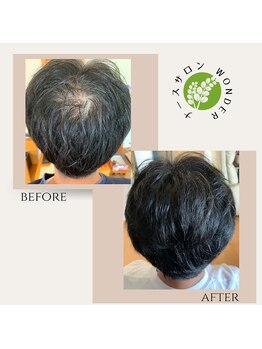 ワンダー(Wonder)/幹細胞エクソソームで髪も元気に