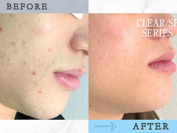 ラッシュ(RUSH)/念願!カミソリ負けとお別れ