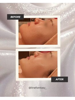 ラインファンタジー 武庫之荘店/リフトアップ・たるみ改善