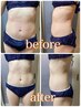 【脂肪分解剤あり1部位】レモンボトルより凄い!?導入キャンペーン中!