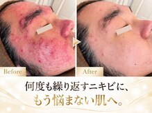 ポアレ(POARE)の雰囲気(繰り返しニキビや毛穴つまりも卒業!変われない人はいないです。)