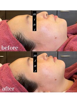 ミント(Mint)/★人気の小顔メニュー★