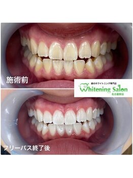ホワイトニングサロン 名古屋駅店/【ホワイトニング施術例】