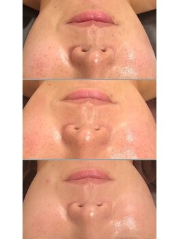 プラム(PLUM)/ハーブ毛穴コース