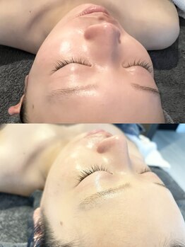 ミニョンボーテ(mignon beaute)/before/after 30代