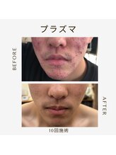 エステサロン 美飾り イオンモール木更津店/before⇒afteｒ/プラズマ