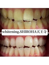 シロハ(SHIROHA)/セルフホワイトニング/天王寺